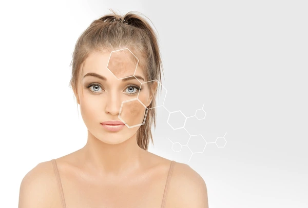 Carbon Laser Treatment in Lucknow