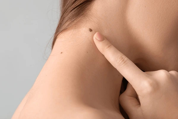 Mole Removal Treatment in Lucknow